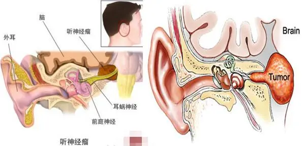 听神经瘤3期