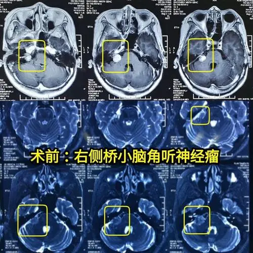 听神经瘤MRI